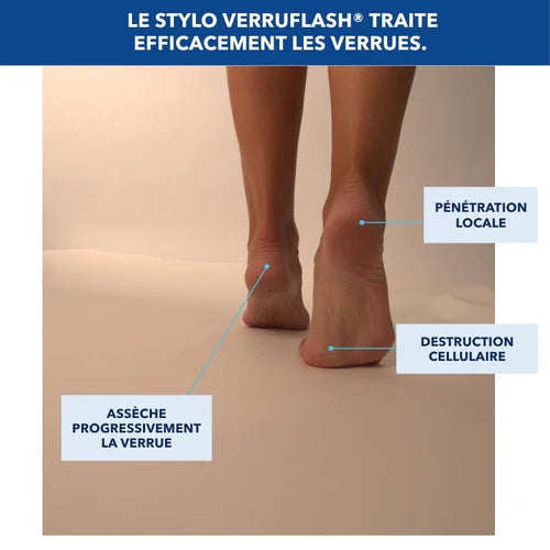 ✋🦶 VERRUFLASH® – Stylo de traitement des verrues mains, pieds et corps