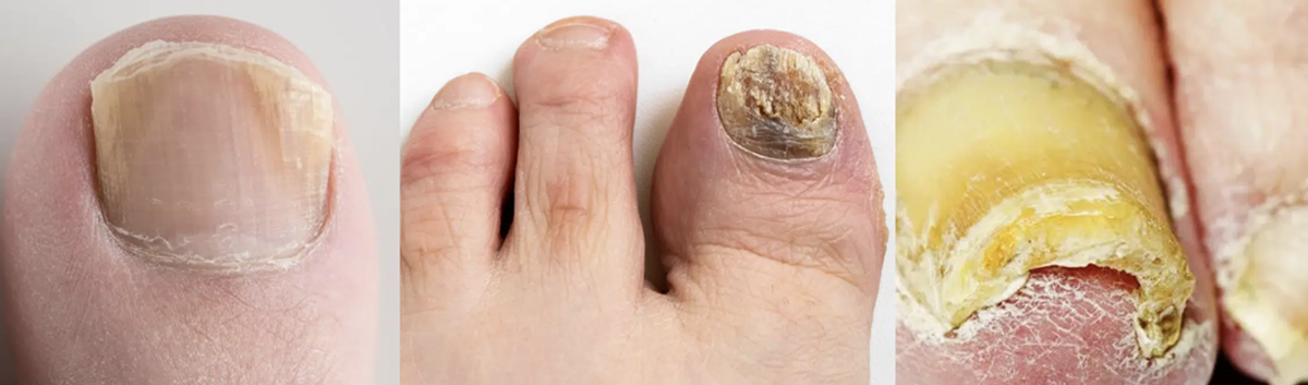 Mycose des ongles : faut-il croire aux remèdes trouvés sur internet ?