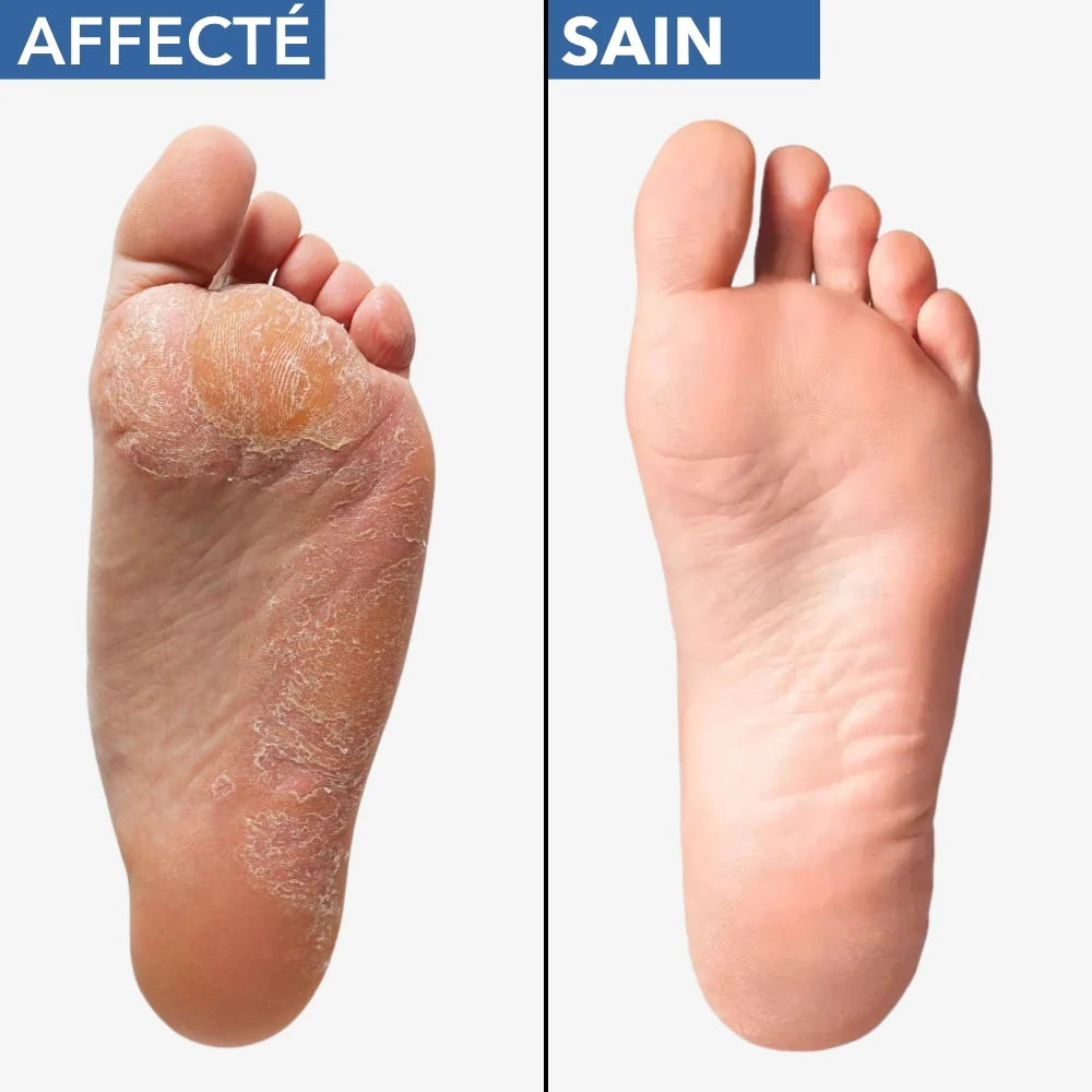 🦶💨 MYCOFLASH® – Spray SPRAY ANTIFONGIQUE POUR LE PIED D'ATHLÈTE (25 ml)